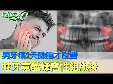 牙痛腫起來|牙痛臉腫，竟是蛀牙成蜂窩性組織炎和鼻竇炎